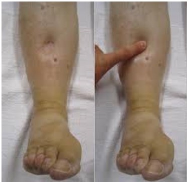 Photo of leg swelling