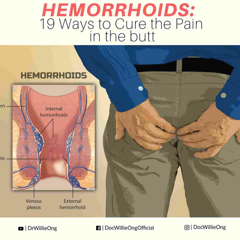 cartoon photo shows of a man holding his butt and on the left side the human anatomy of an anus.