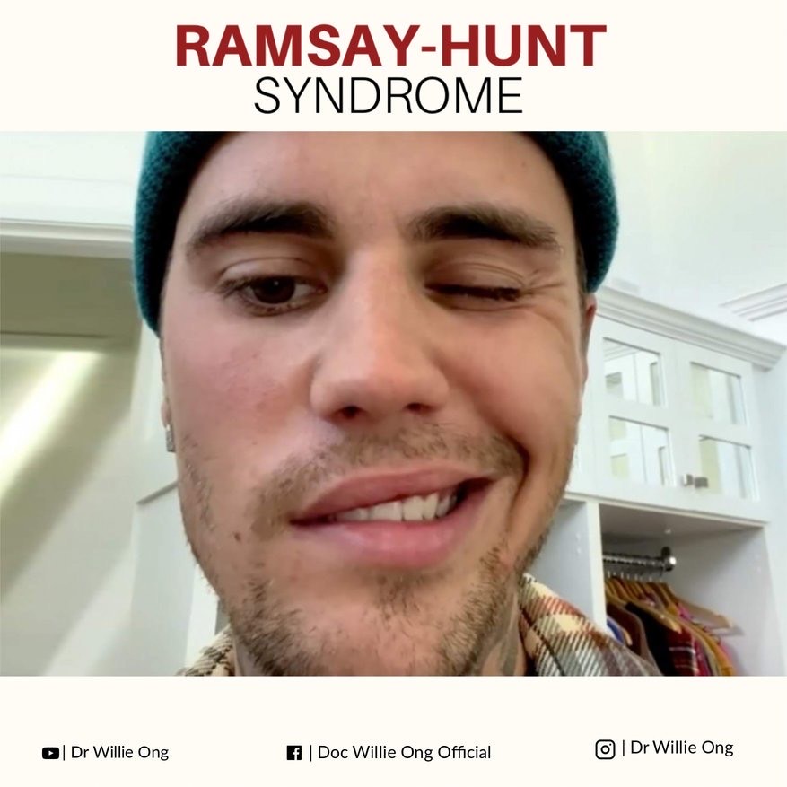 Ramsay-Hunt Syndrome